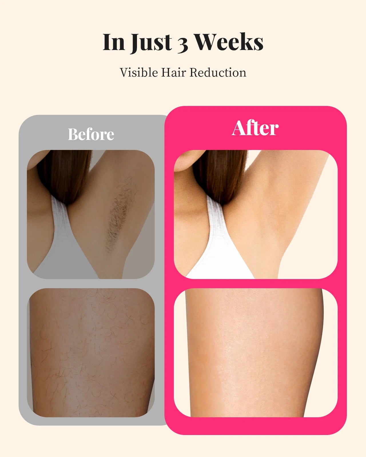 IPL Hair Removal Device with 990,000 Flashes – 9 Energy Levels for Body, Face and Bikini - Vellévia